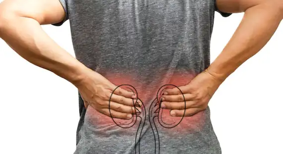 kidney stones symptoms